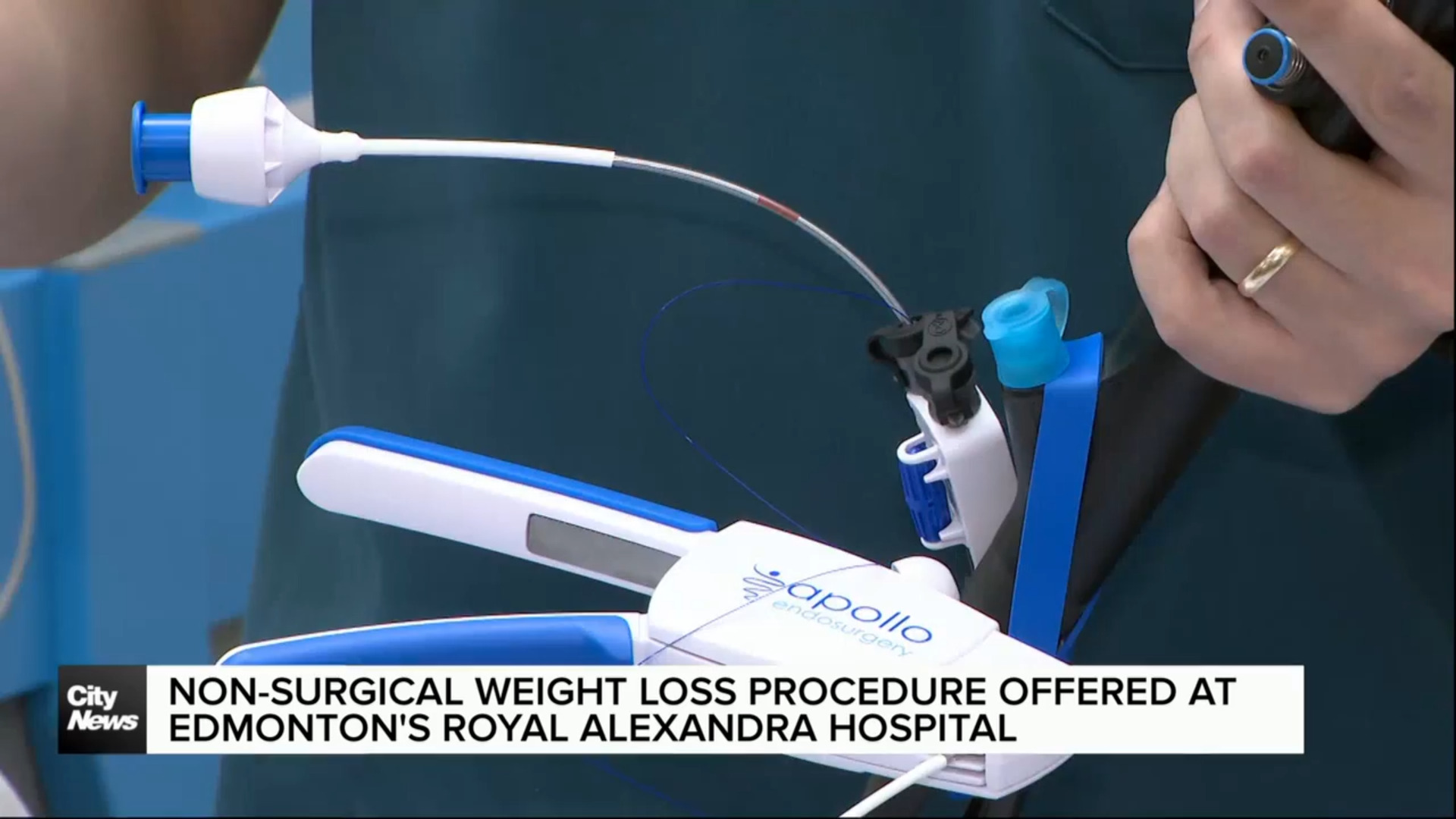 Non-surgical weight loss procedure offered at Edmonton’s Royal Alexandra Hospital