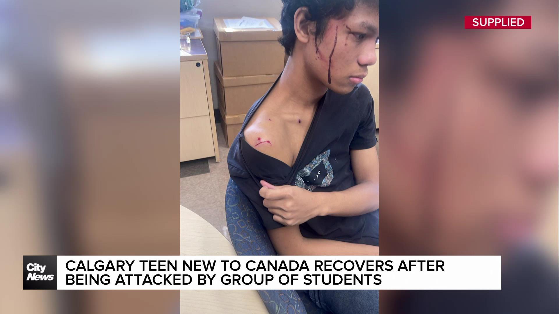 Calgary teen new to Canada recovering after being attacked by group of students