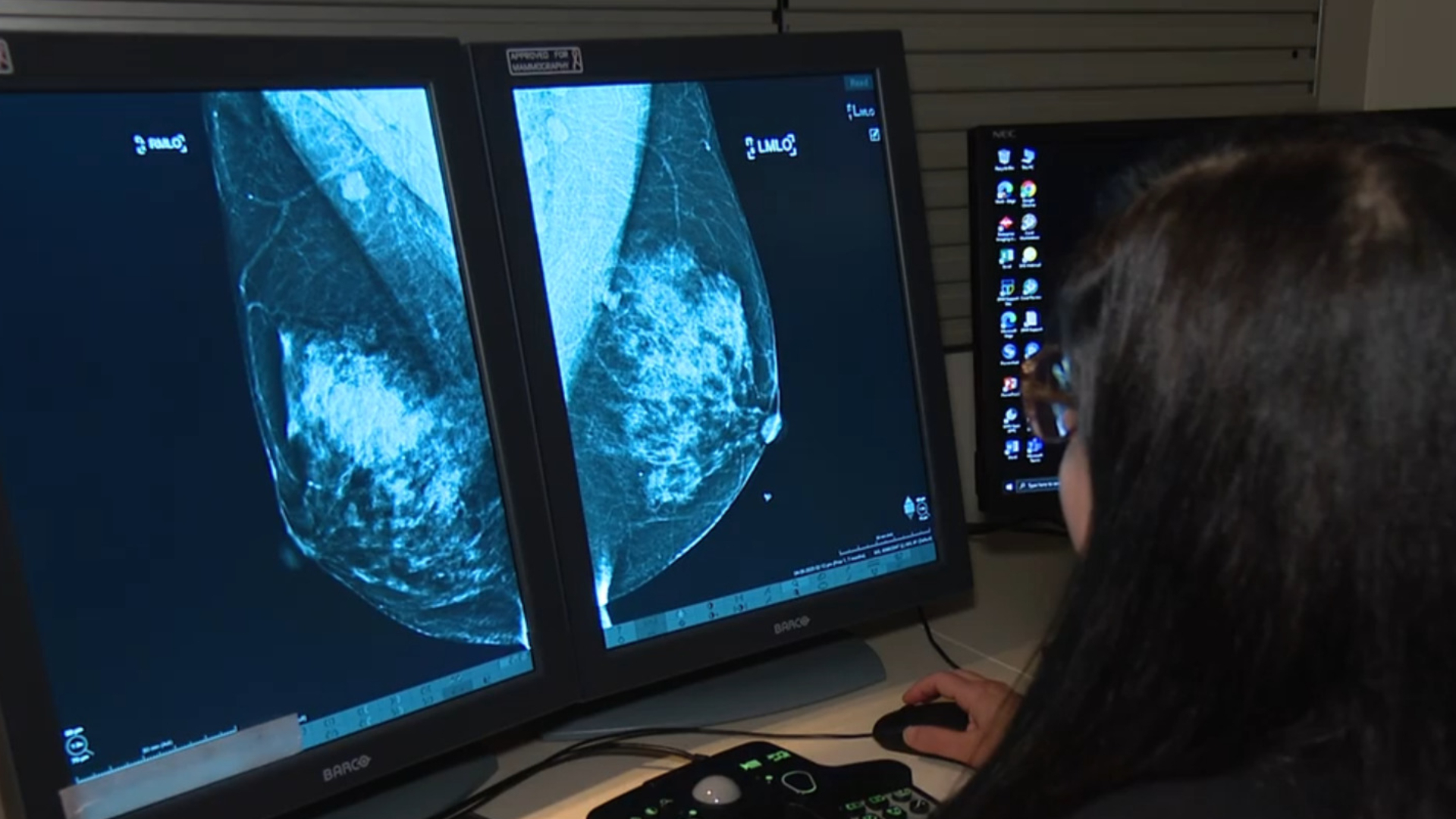 Benefits of earlier breast cancer screenings