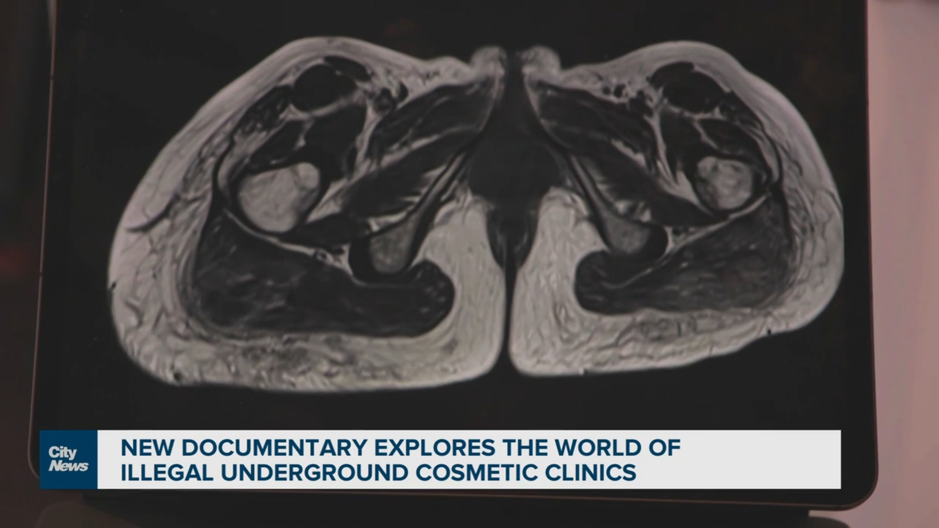 'Foreign substances in my body:' Women still dealing with pain years after cosmetic procedure