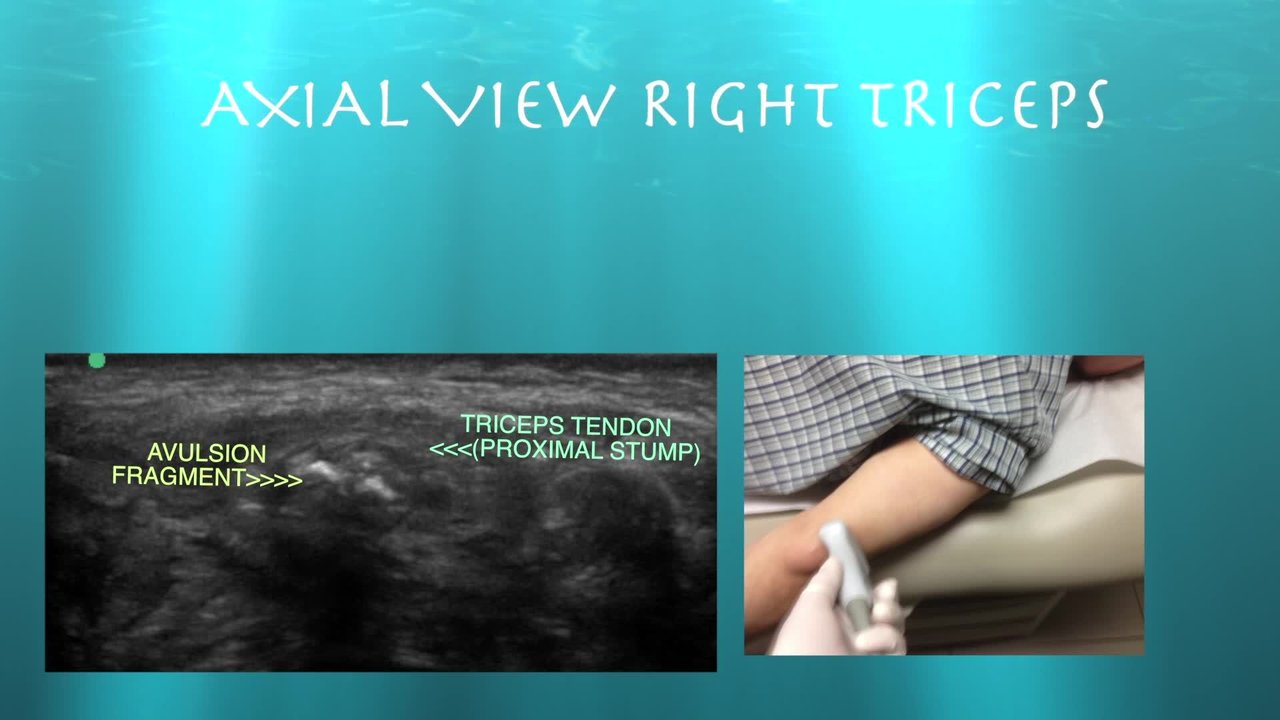 Triceps Tendon Tear Usg