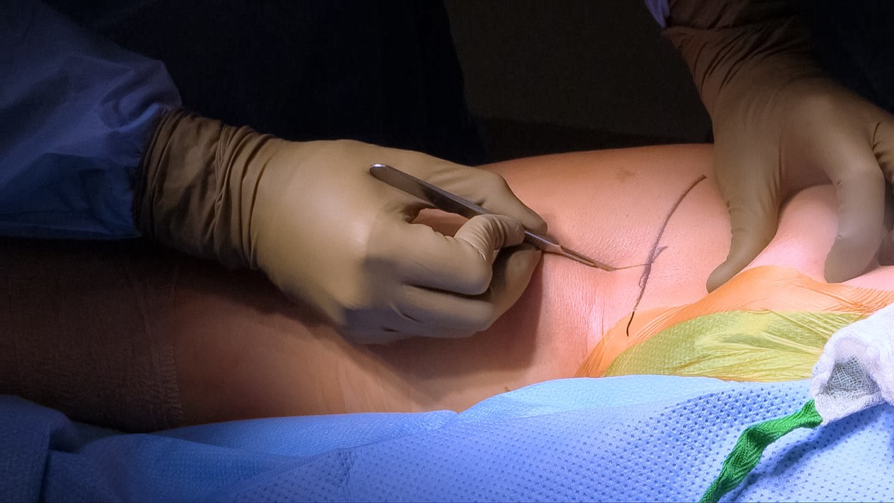 Proximal Hamstring Reconstruction with Achilles Allograft and Sciatic  Neurolysis, image size:1280x720