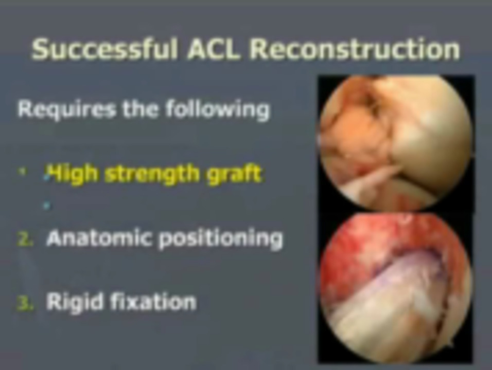 Anatomic Single Bundle ACL Reconstruction using an Anteromedial Portal |  VuMedi