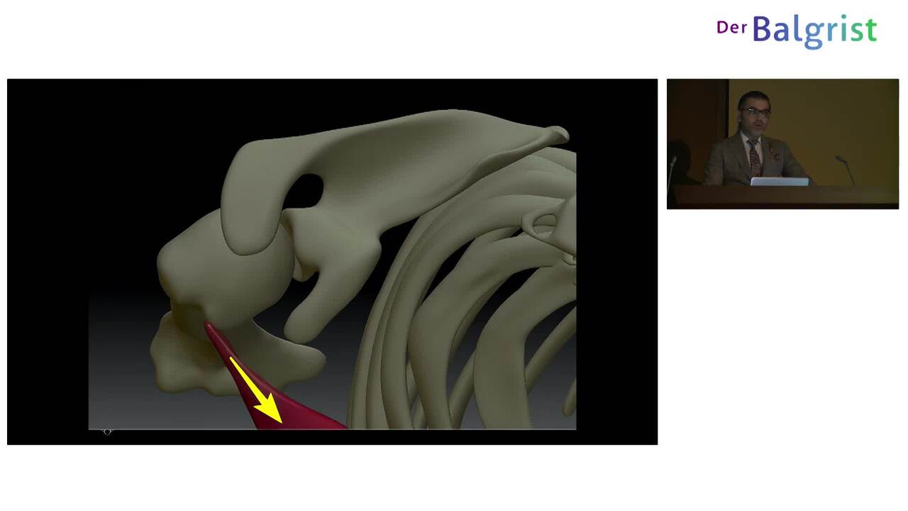 Anterior Latissimus Dorsi Transfer: My Surgical Technique | VuMedi Anterior Latissimus Dorsi Transfer: My Surgical Technique | VuMedi