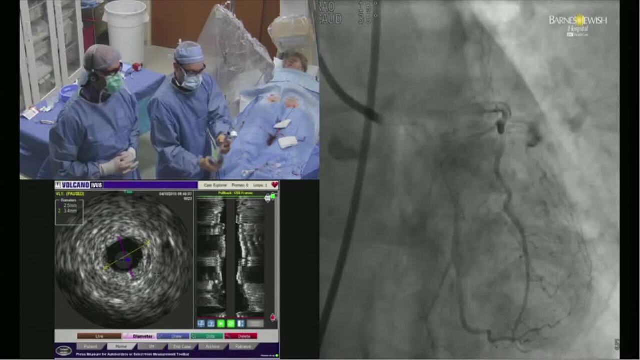 COMPLEX CORONARY / BIORESORBABLE VASCULAR SCAFFORD (BVS) Barnes Jewish  Hospital | VuMedi