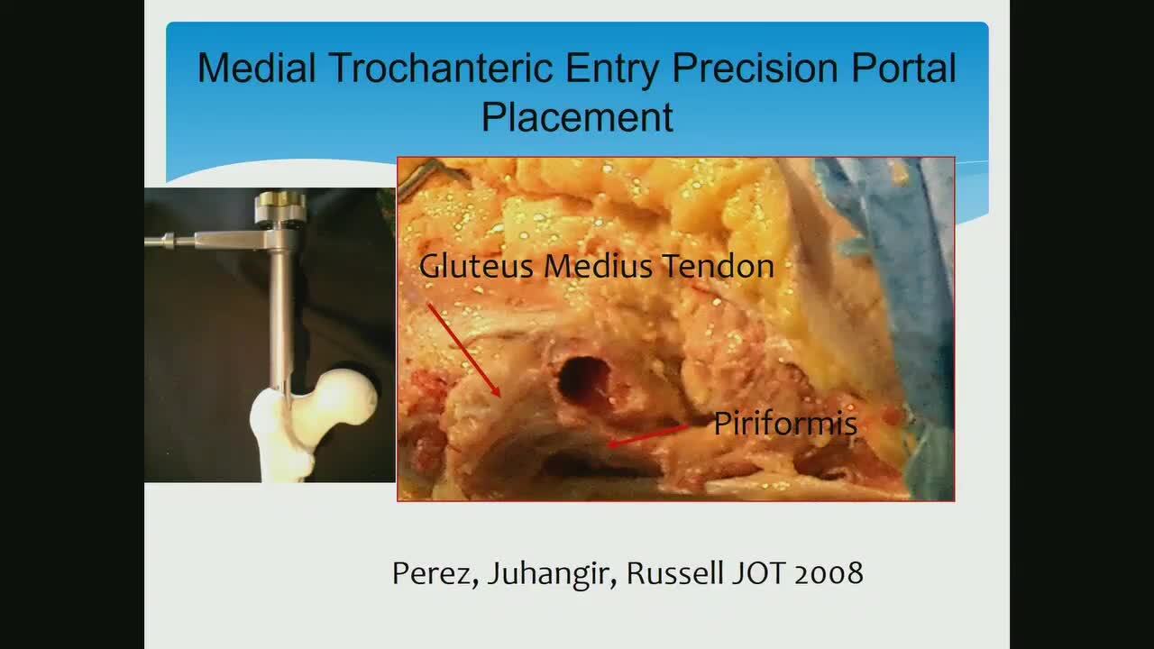 Nailing Intertrochanteric Fractures: Long or Short Nails and Technical Tricks | VuMedi Nailing Intertrochanteric Fractures: Long or Short Nails and Technical Tricks | VuMedi