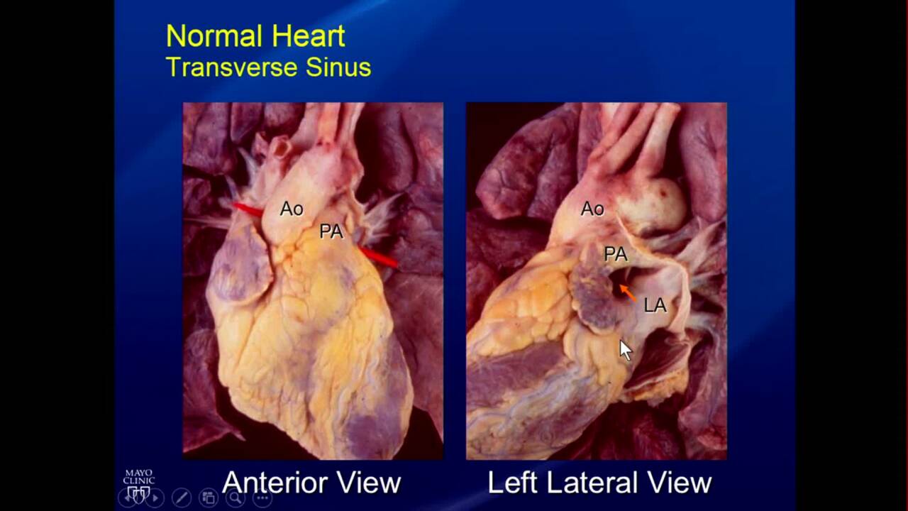 transverse sinus heart