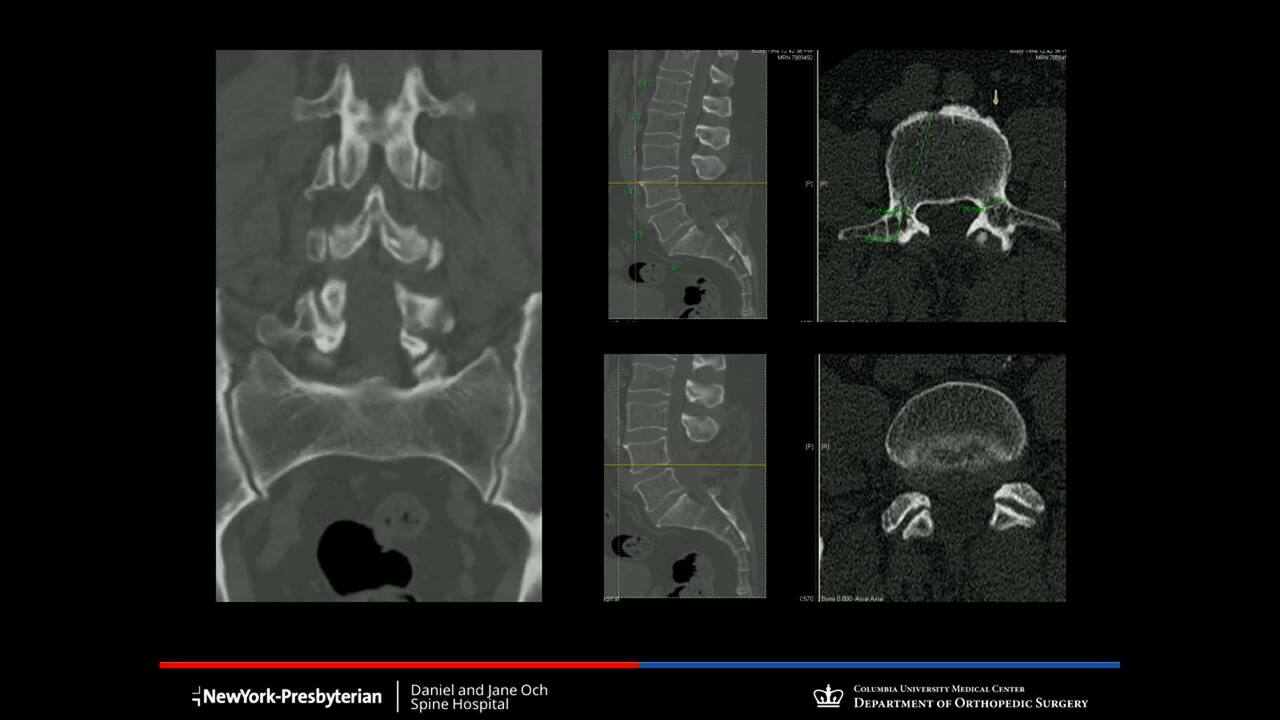 Lumbar Spinal Stenosis  Columbia Orthopaedic Group