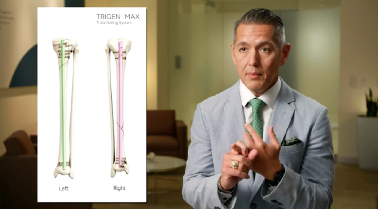 Next Level Nailing: Maximizing New Tibia Nail Technology for Orthopedic  Trauma Care