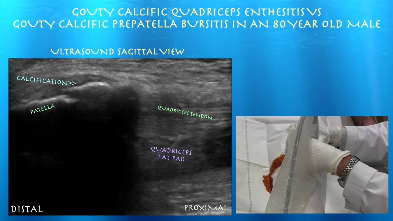 quadriceps tendon calcification