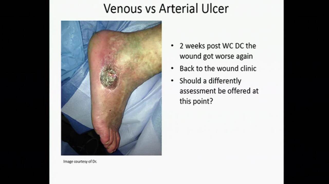 venous ulcer vs arterial ulcer