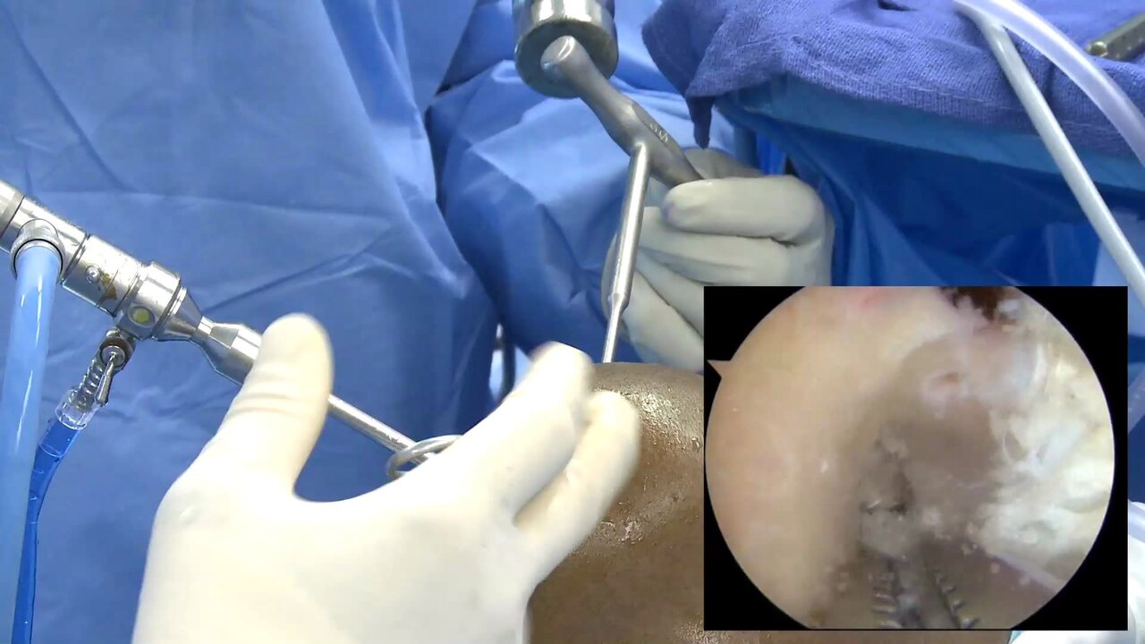 Revision ACL reconstruction with quadrupled semitendinosus