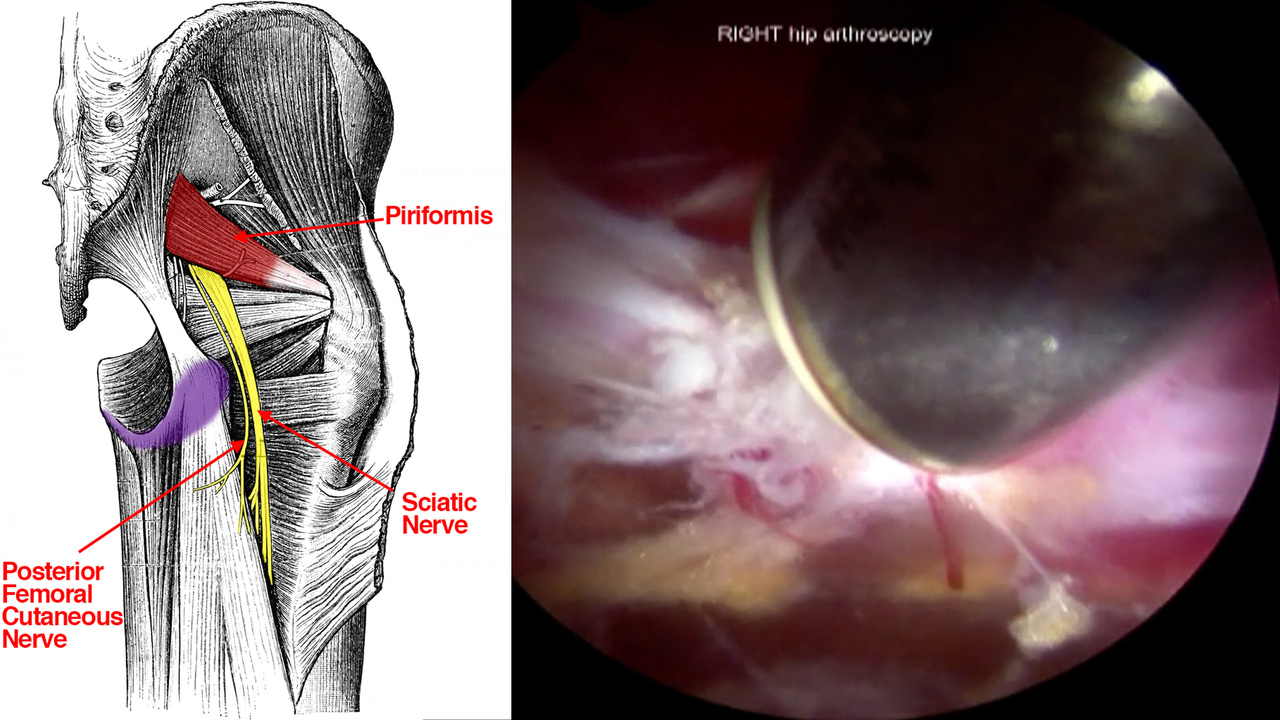 Sciatic Nerve Decompression: Background, Indications, Technical  Considerations