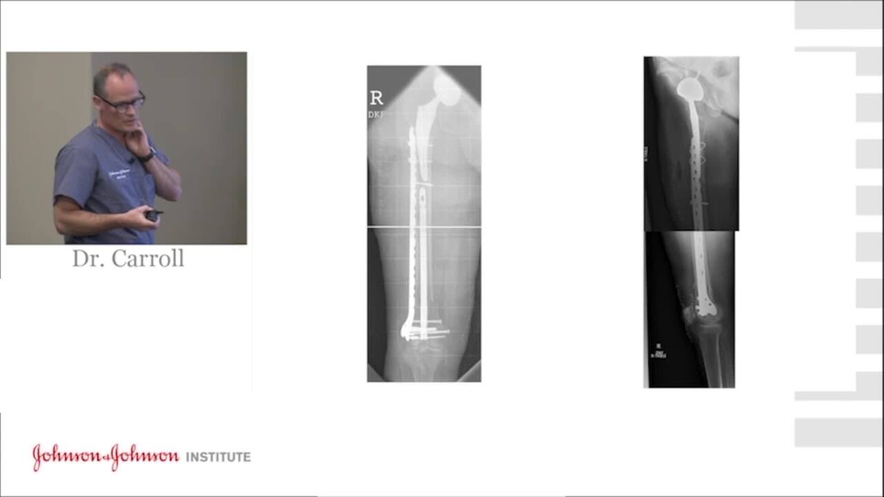Periprosthetic Femur Fractures: Vancouver C | VuMedi