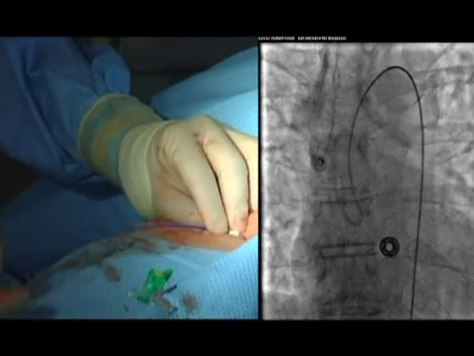 Cath Lab Basics: Routine Coronary Angiography | VuMedi Cath Lab Basics: Routine Coronary Angiography | VuMedi