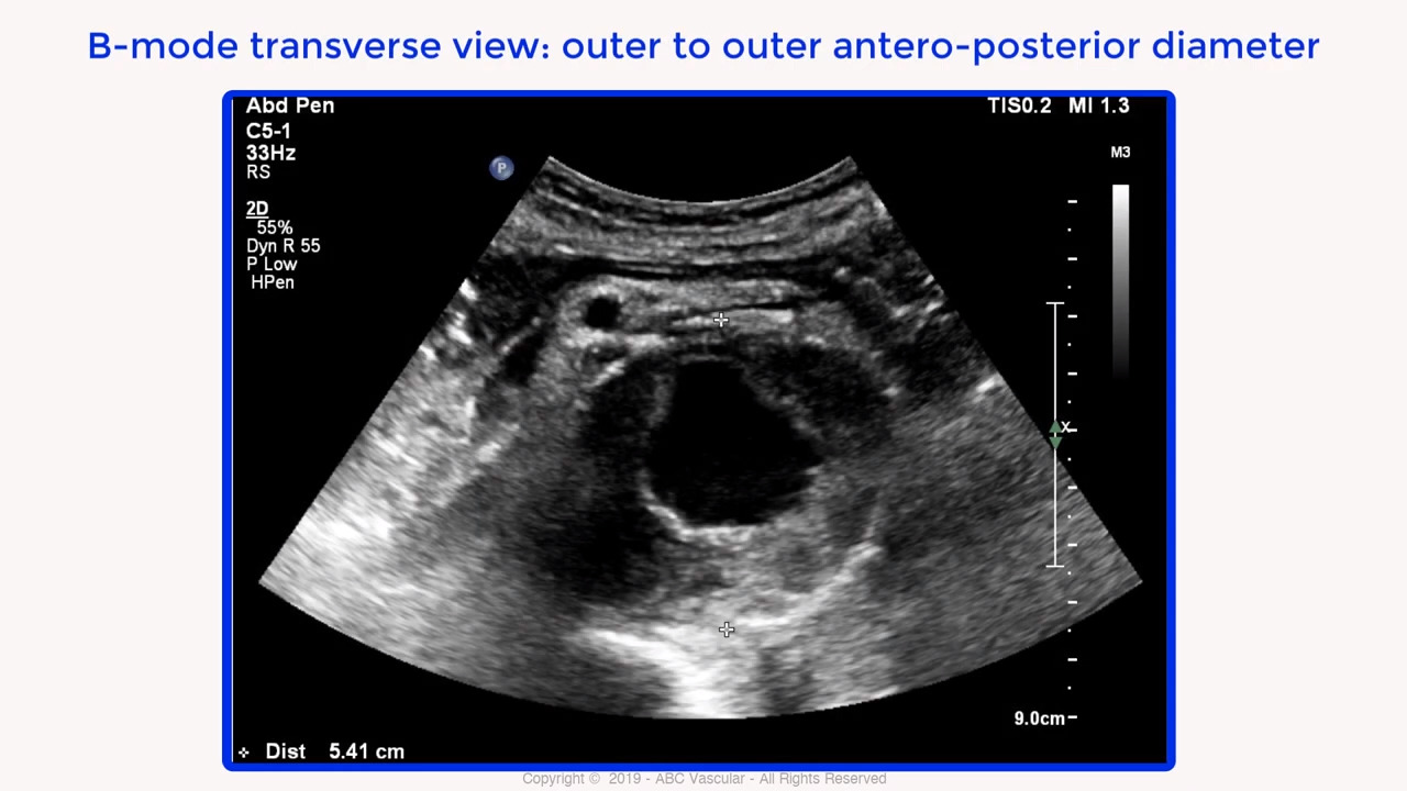 abdominal aortic aneurysm ultrasound