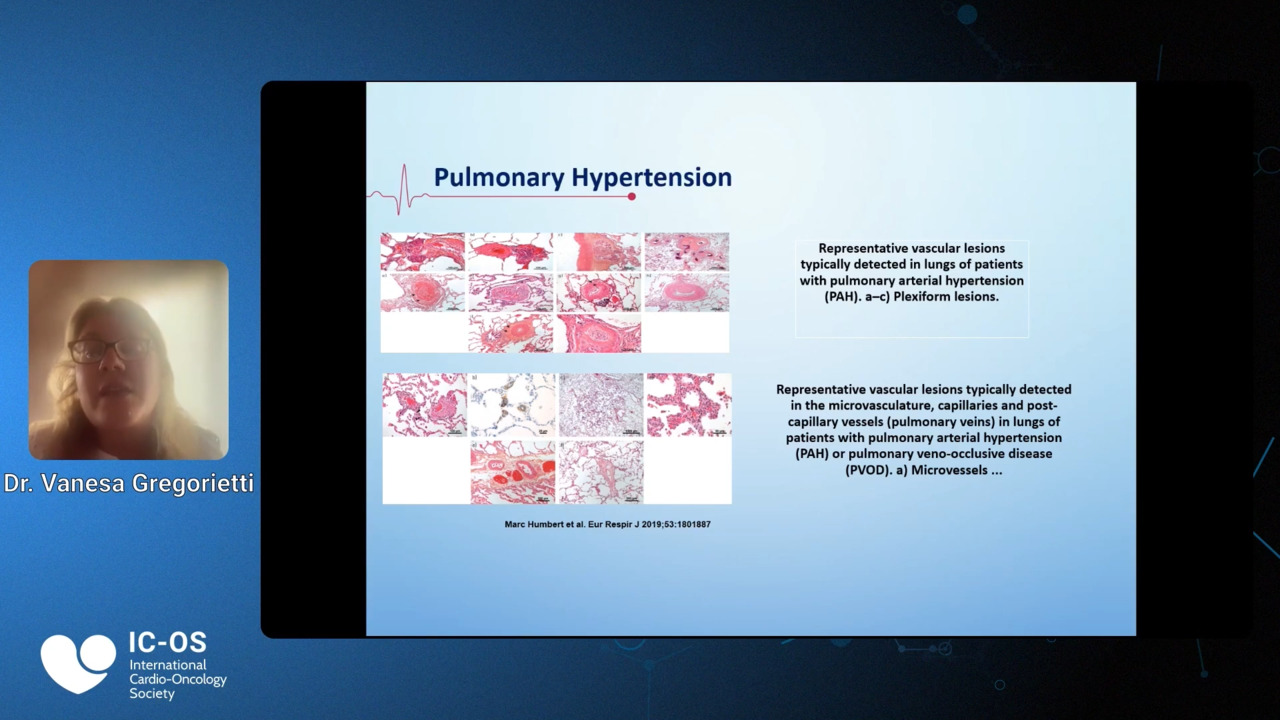 The Challenge of Managing Pulmonary Hypertension in Cancer Patients Radcliffe Cardiology