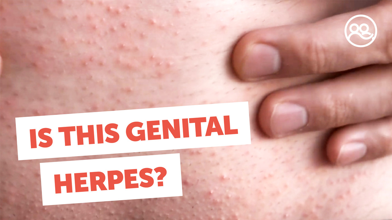Genital Warts, Herpes, STD or STI Treatment Same Day — San Francisco  Dermatology | Best Dermatologist Bay Area – carencampbellmd, image size:1280x720