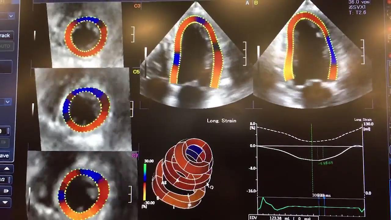 Strain Imaging Improves Cardiac Surveillance of Certain Breast