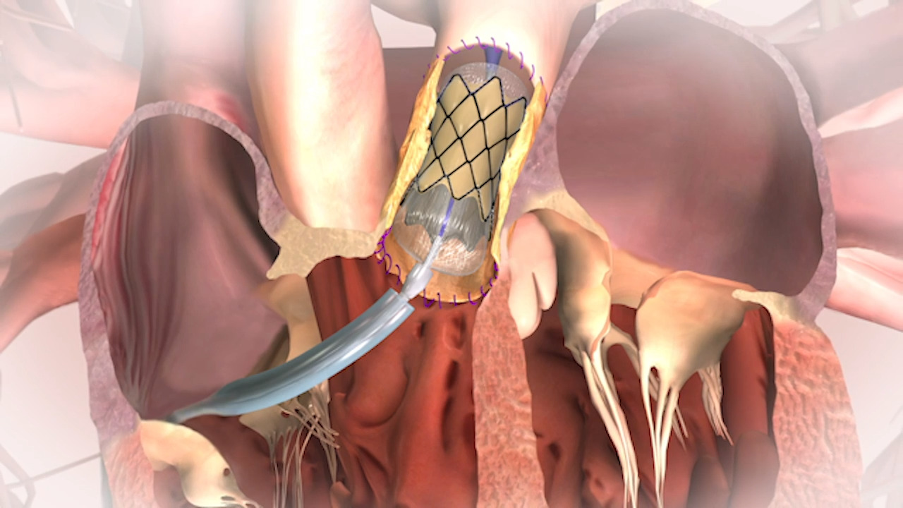 VIDEO: Roles of the Melody and Harmony Transcatheter Pulmonary Valves in  Congenital Heart Disease | DAIC