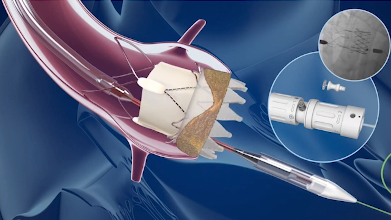 Global Interventional Cardiology Devices Market 25.6 Billion by 2029