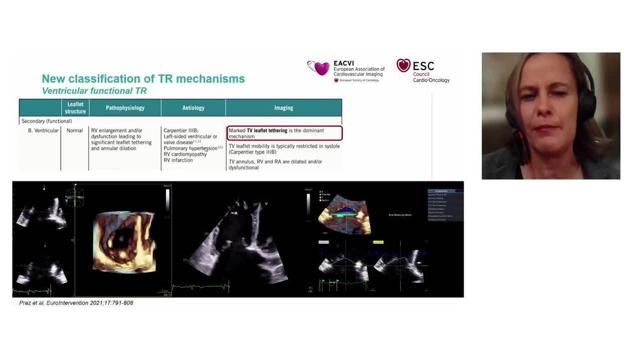 New vision of the tricuspid valve