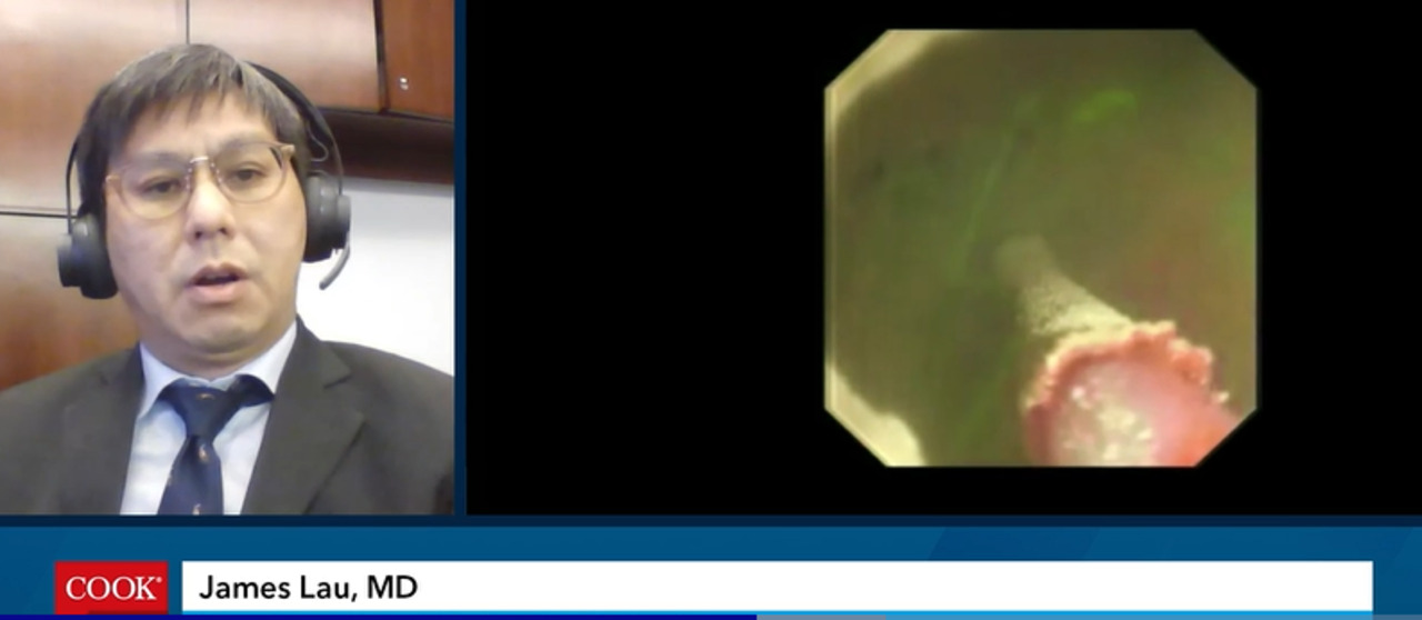 Hemospray® clinical data review - James Lau, MD Video Thumbnail