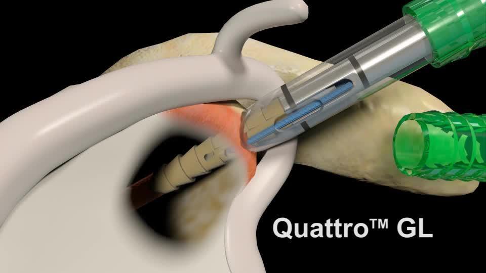 Quattro® GL/GL2 Suture Anchor | Zimmer Biomet