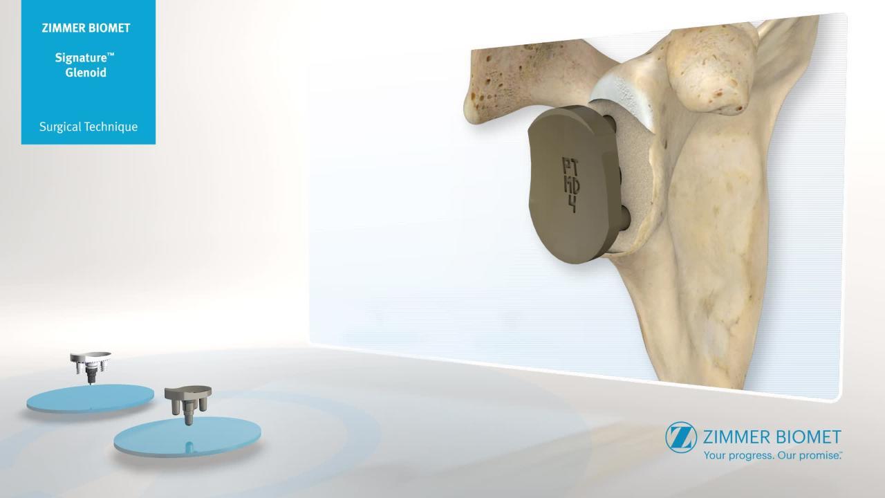 Shoulder Technology | Signature Glenoid Technology | Zimmer Biomet