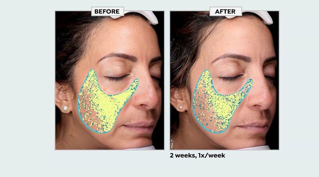 Dr. Brandt Microdermabrasion Advanced Face Exfoliator - 23648630 | HSN