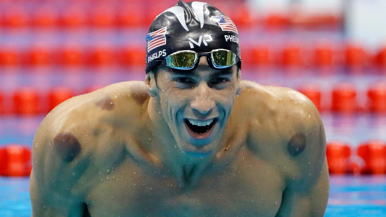 Olympic bruises: How effective is cupping?