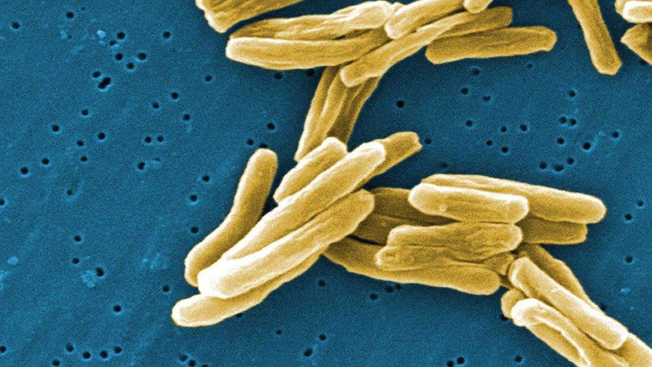 Смъртоносна епидемия от туберкулоза ТБ се появи в хотел в