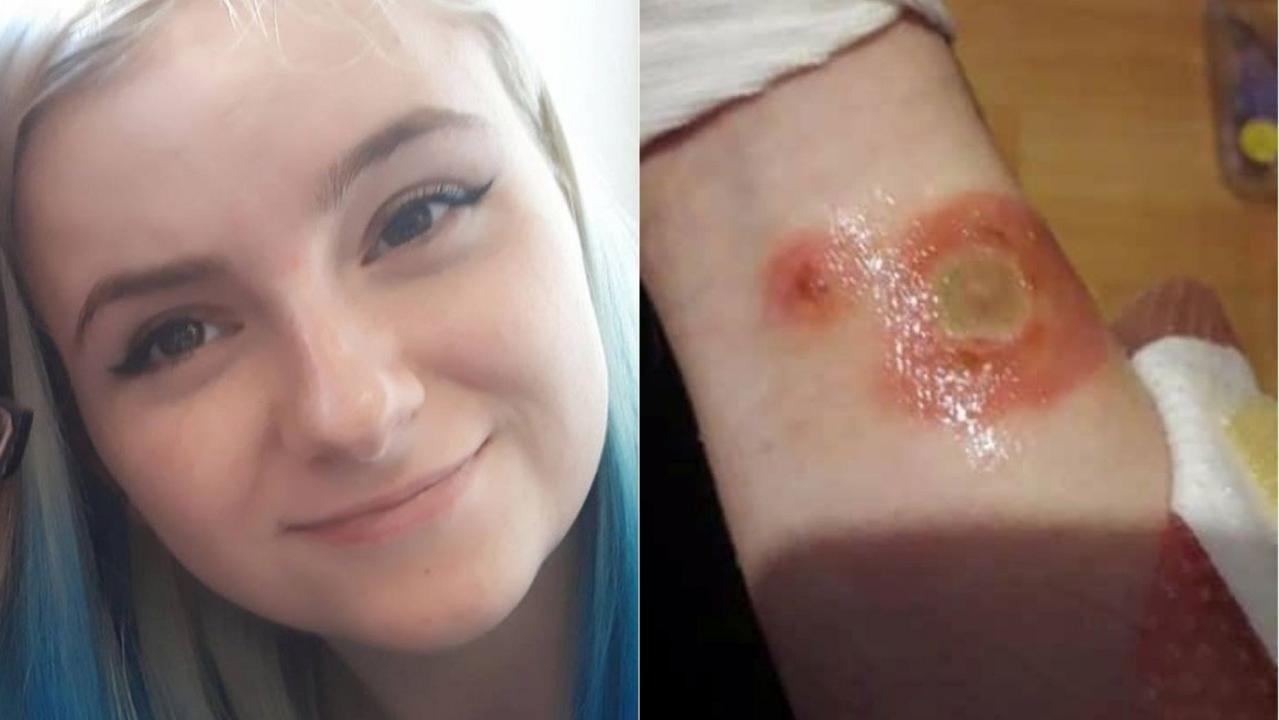'Deodorant Challenge' leaves teen with second-degree burns