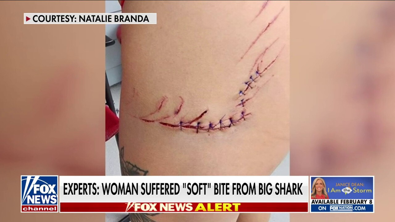 Florida woman survives shark attack, receives 14 stitches 