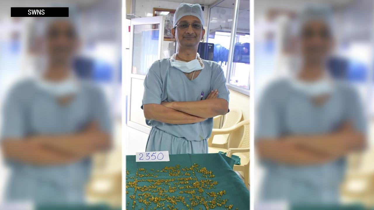 Outrageous surgery: Doctors remove 2,350 gallstones from woman’s gallbladder 