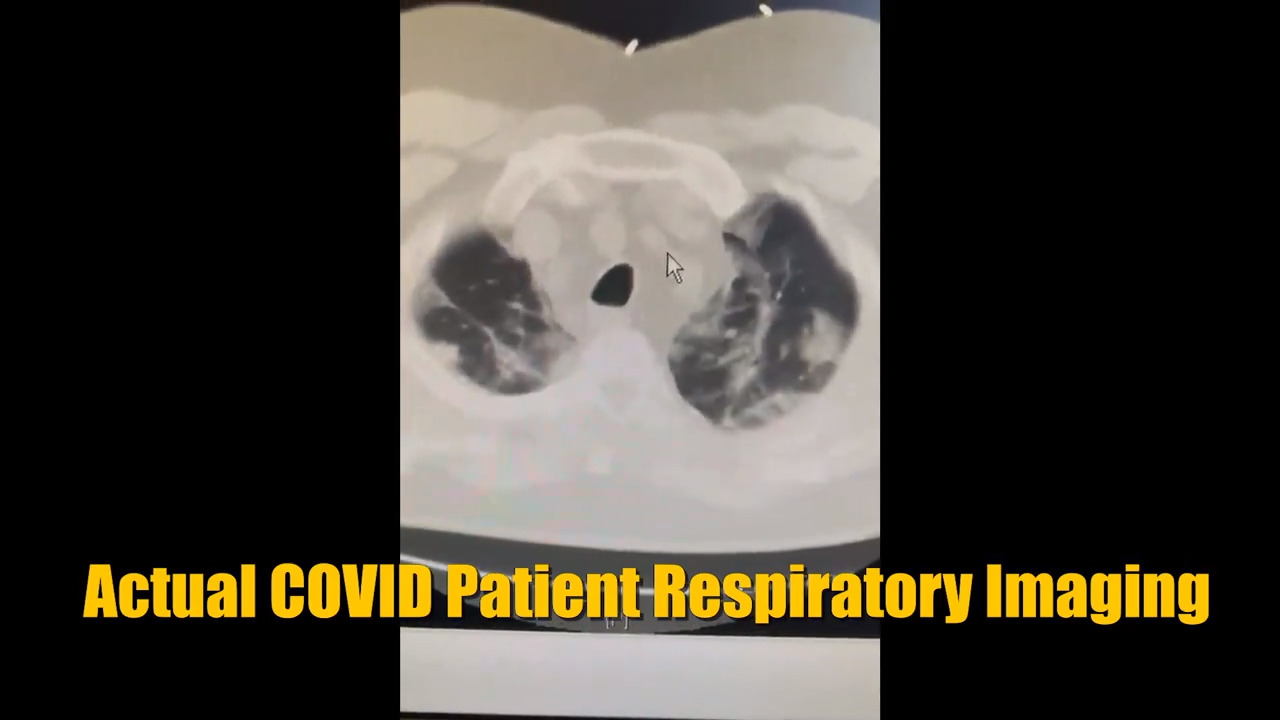 Doctor shows how COVID-19 affects the lungs of severely sick patients