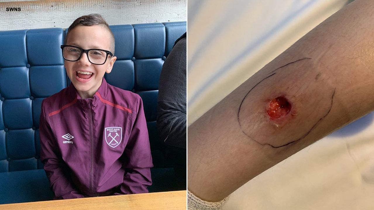 Apparent spider bite leaves boy with gruesome hole in his leg