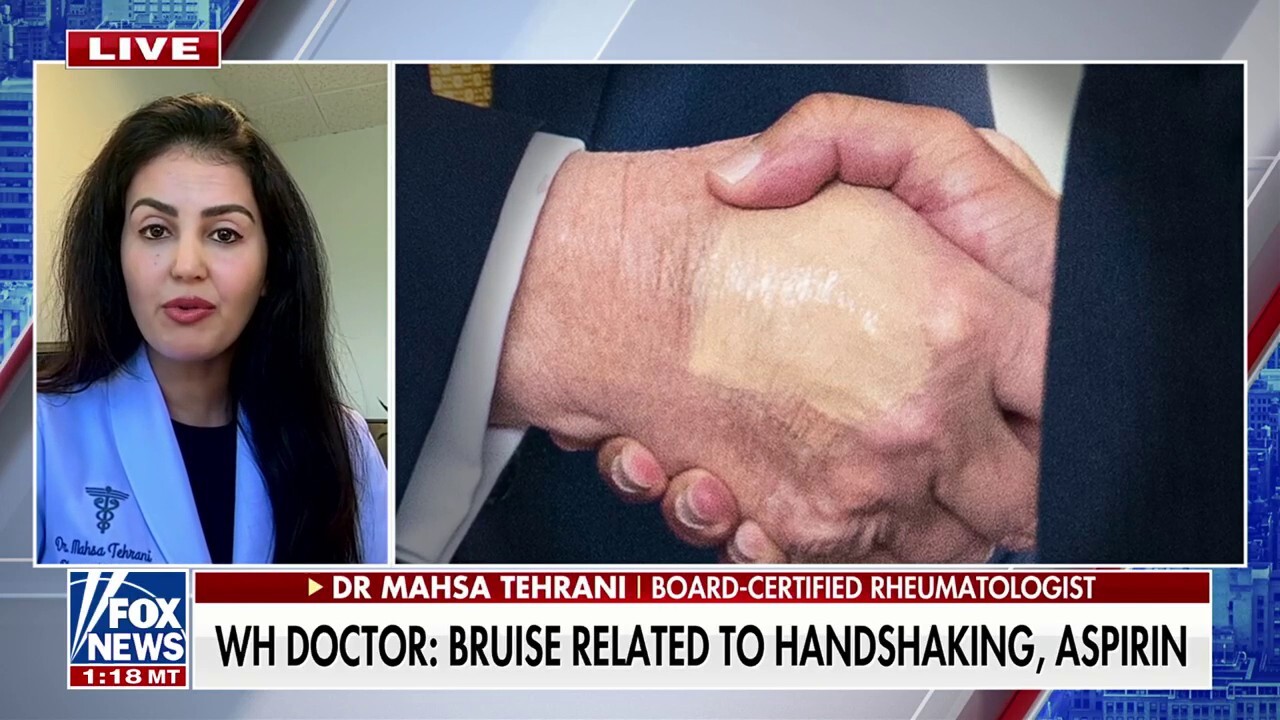  ‘McDonald’s has to go,’ says rheumatologist after President Trump’s Chronic Venous Insufficiency diagnosis