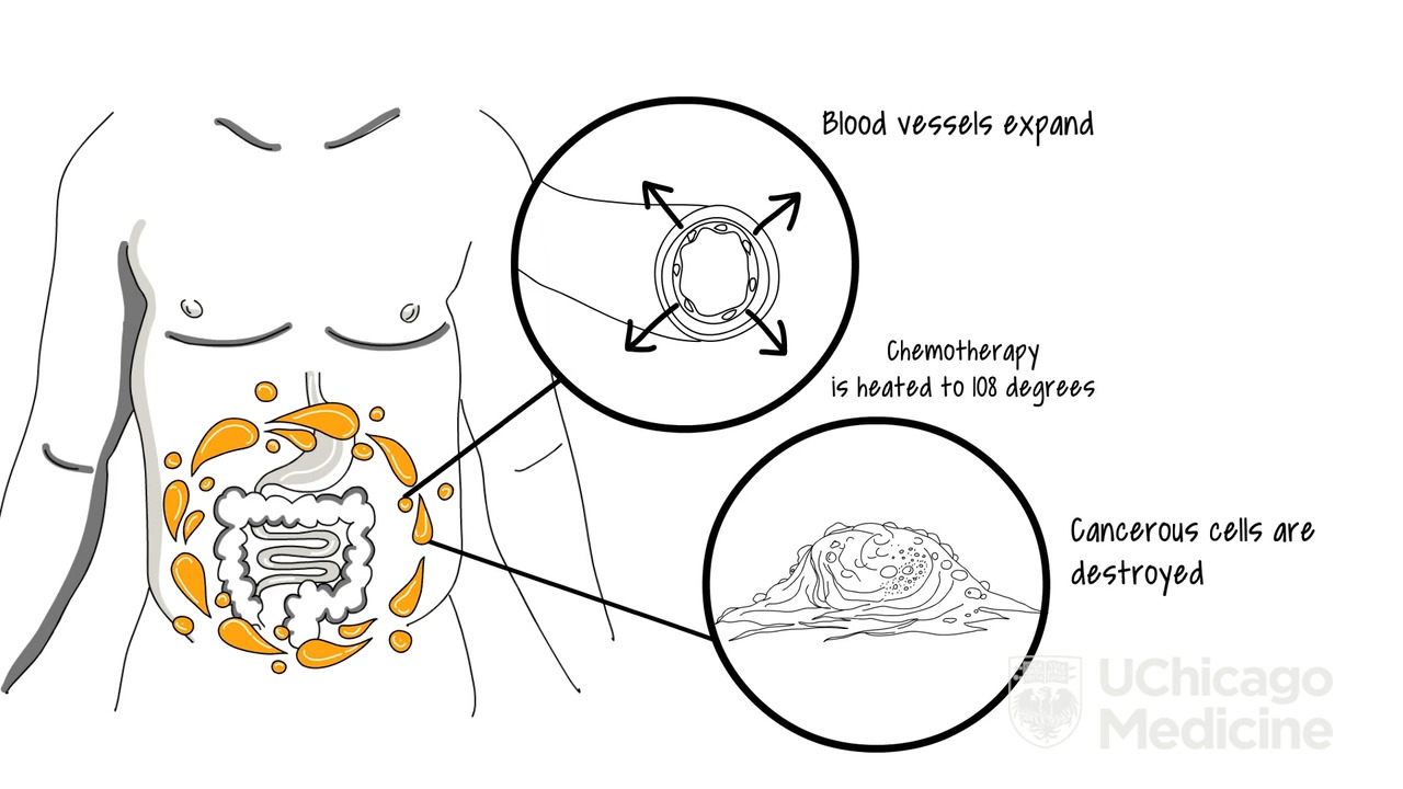 Heated Chemotherapy Treatment: How It Works 