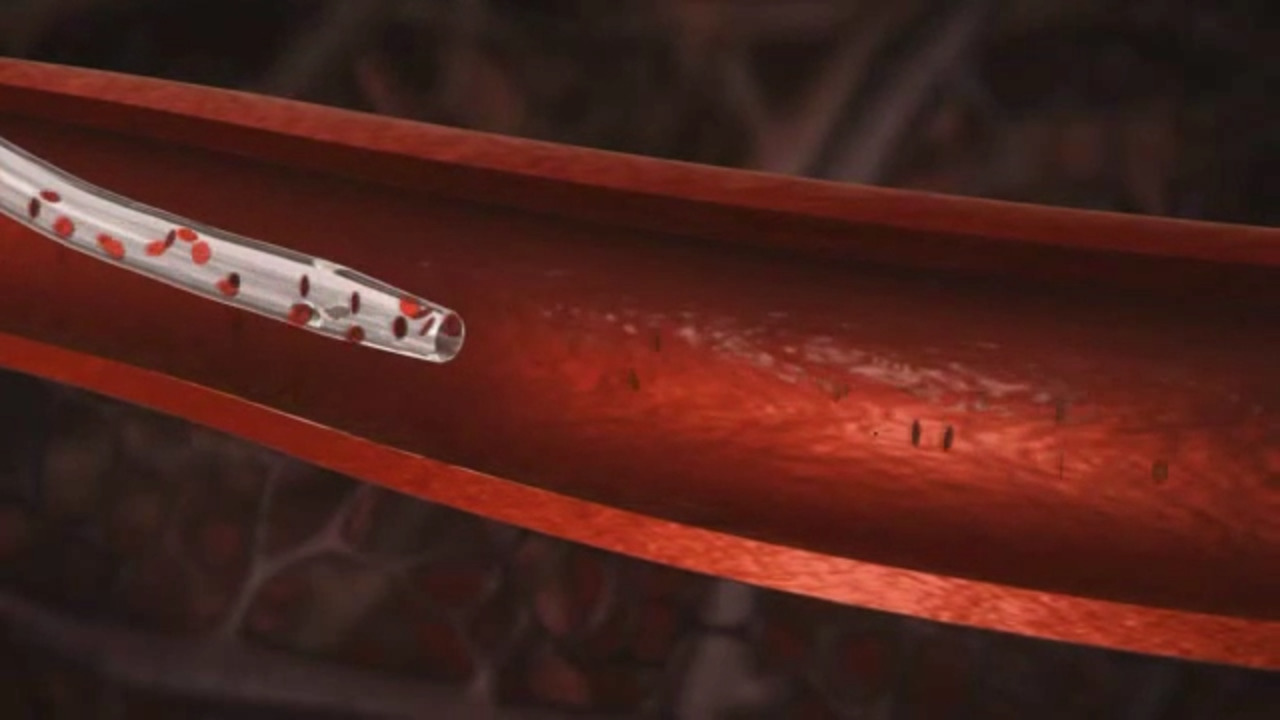 icoon♡ BD Nexiva™ Diffusics™ Closed IV Catheter System, 18 G x 1.25