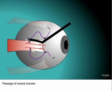Surgical Outcomes Following Rectus Muscle Plication: A Potentially Reversible, Vessel-Sparing Alternative to Resection | Ophthalmology | JAMA Ophthalmology | JAMA Network Surgical Outcomes Following Rectus Muscle Plication: A Potentially Reversible, Vessel-Sparing Alternative to Resection | Ophthalmology | JAMA Ophthalmology | JAMA Network