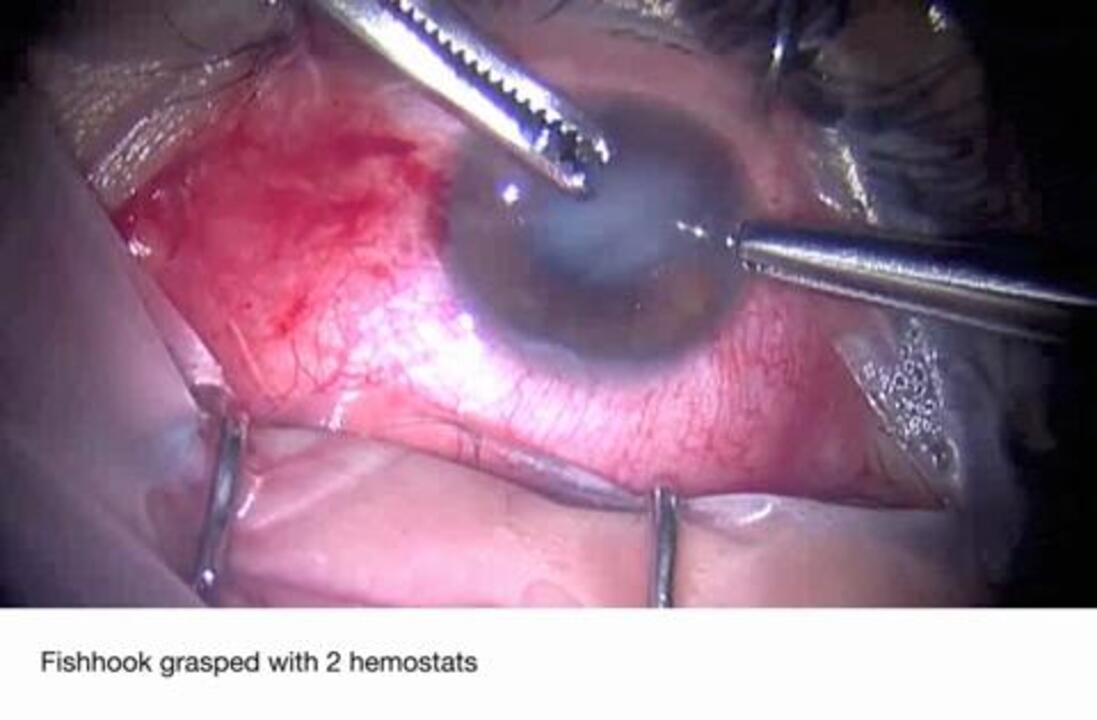 Penetrating Ocular Fishhook Injury, Trauma and Injury, JAMA Ophthalmology