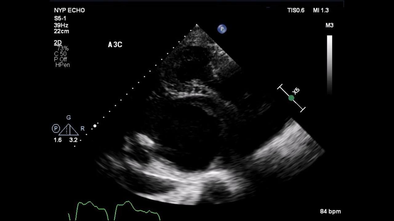 thoracic aortic aneurysm echocardiogram