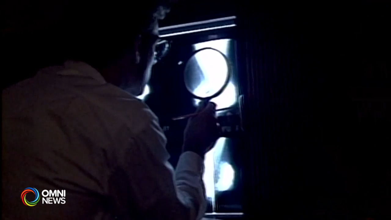 疫情期间女性乳房造影检查减少40万个