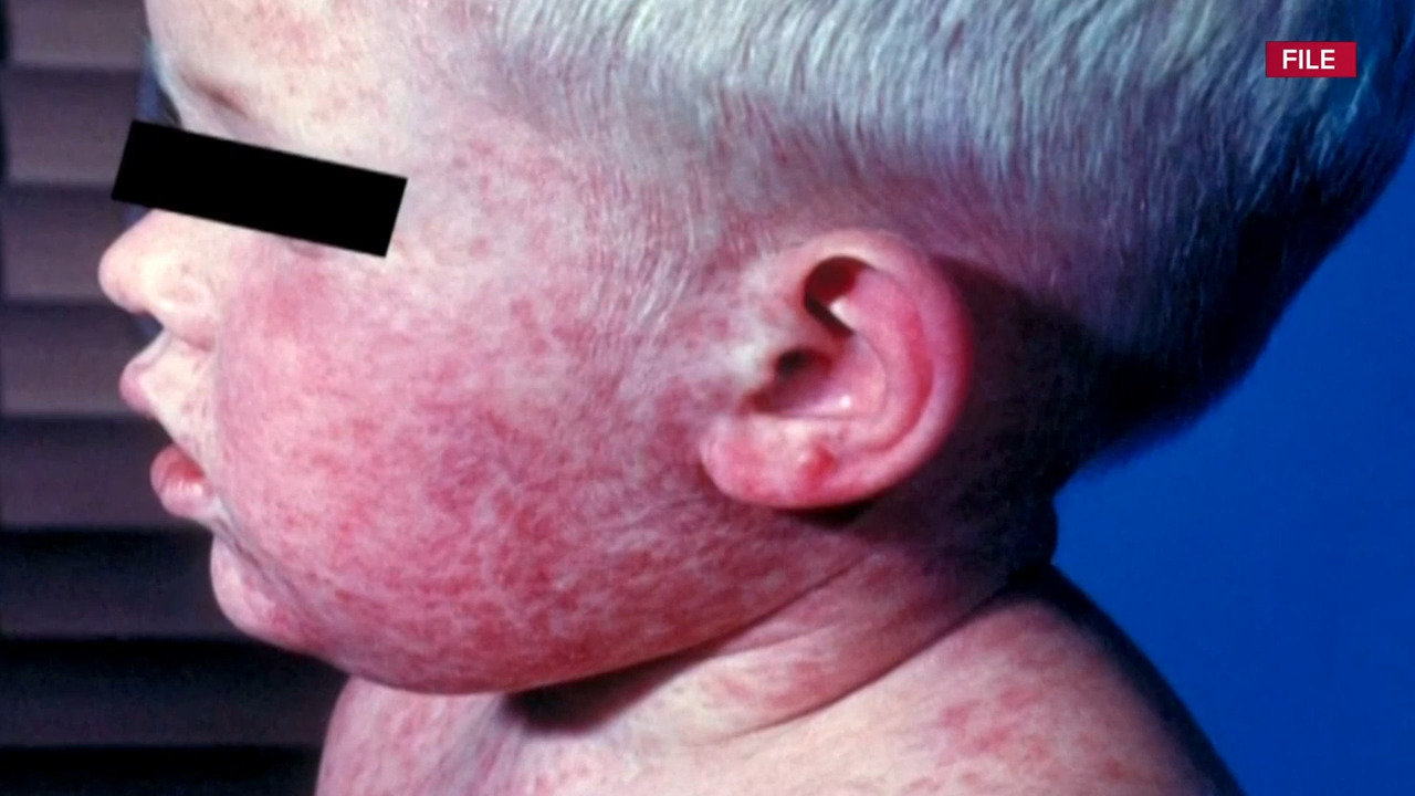 关注WHO移除加拿大麻疹消除国地位