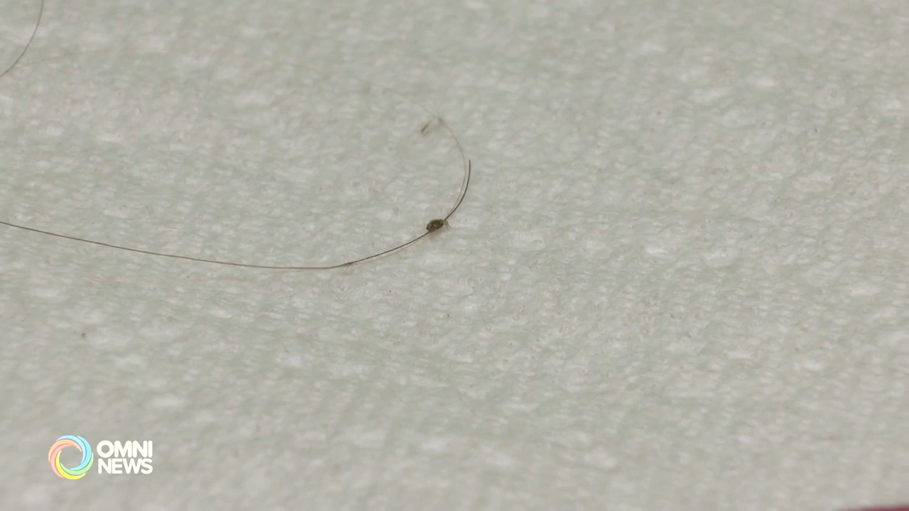 头虱在多伦多有快速传播迹象