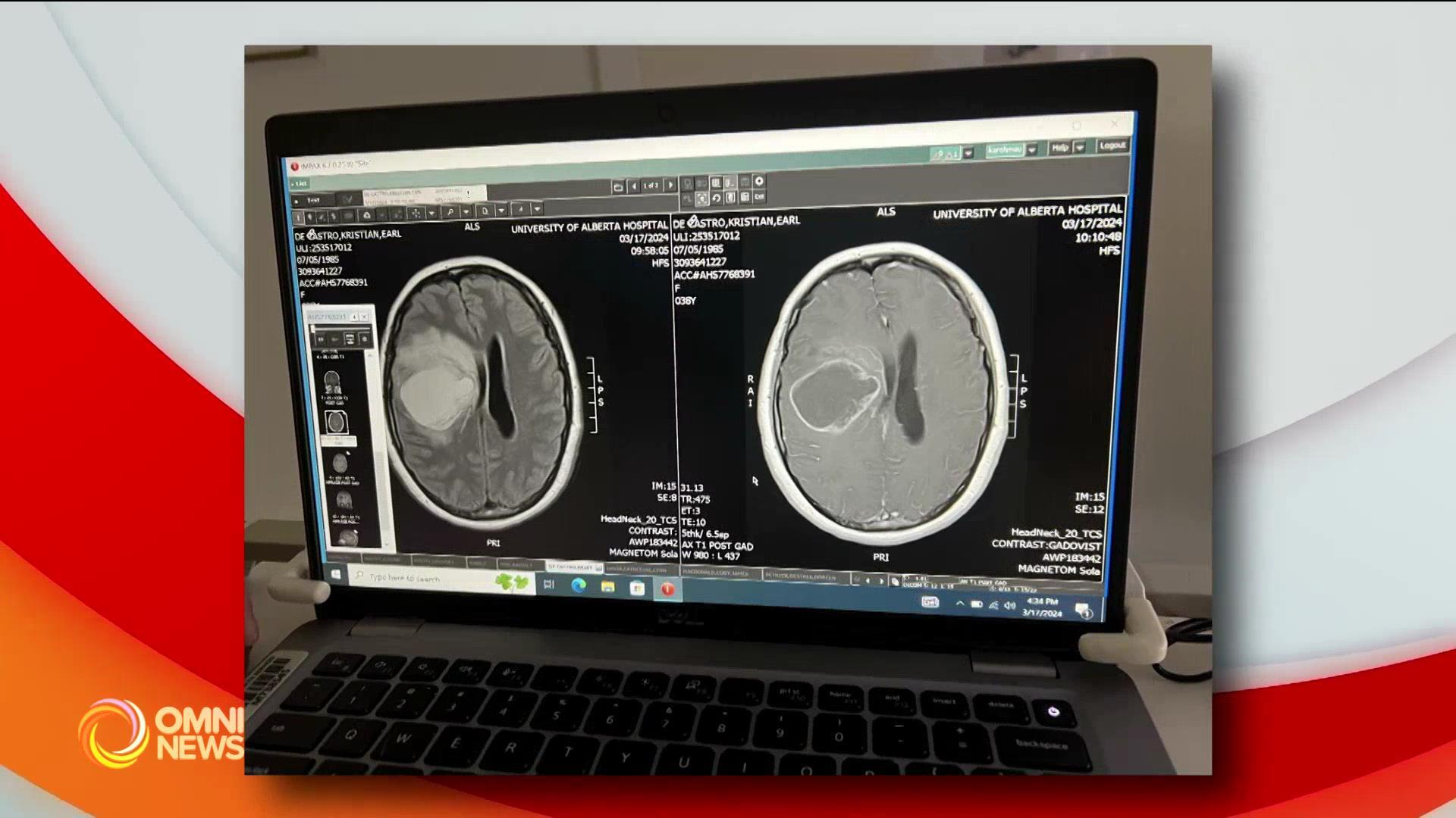 Kararating pa lamang na Pinay international student naoperahan dahil sa brain tumor