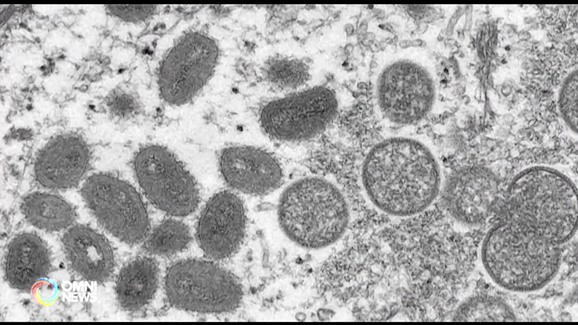 多倫多公共衛生局呼籲高危人群盡快接種猴痘疫苗