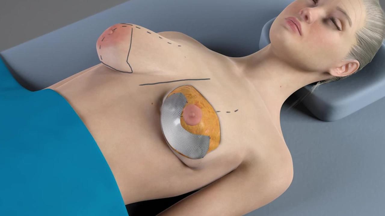 Before After Breast Augmentation, Breast Lift & Internal Bra/Mesh