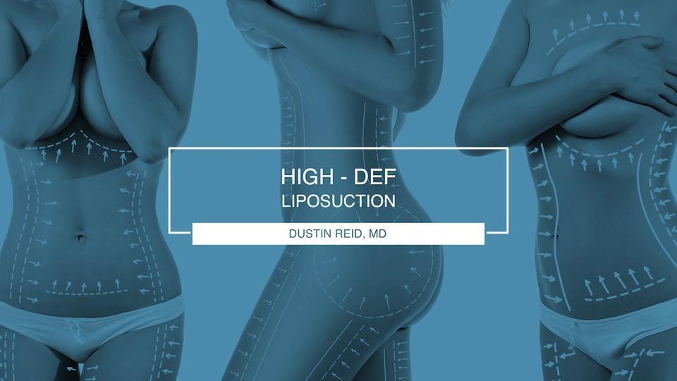 High definition body sculpting - Where art meets surgical science